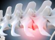 Micro-usinage d'implant intervertébral