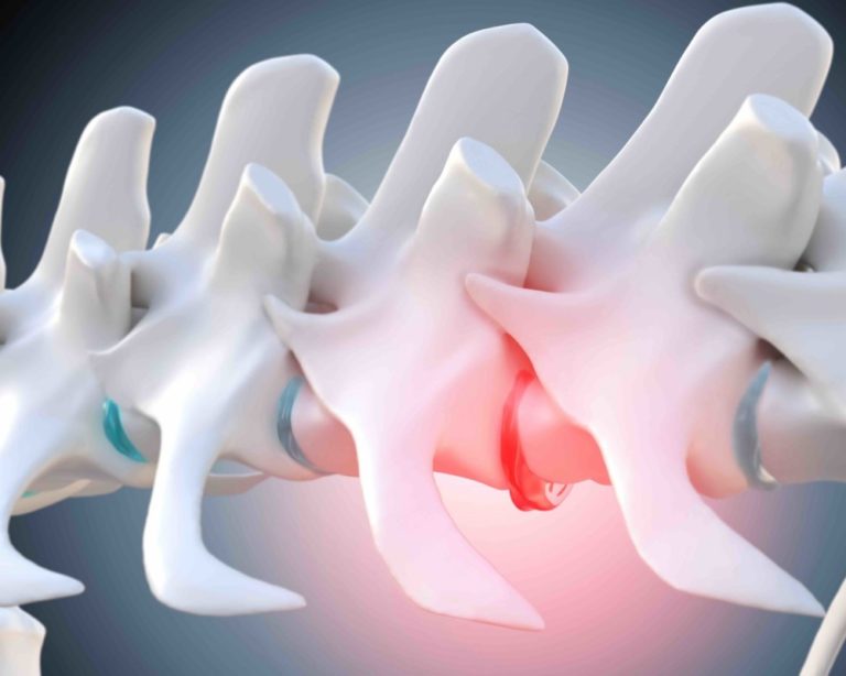Degenerated intervertebral disc of the dog spine Micro-usinage d'implant intervertébral